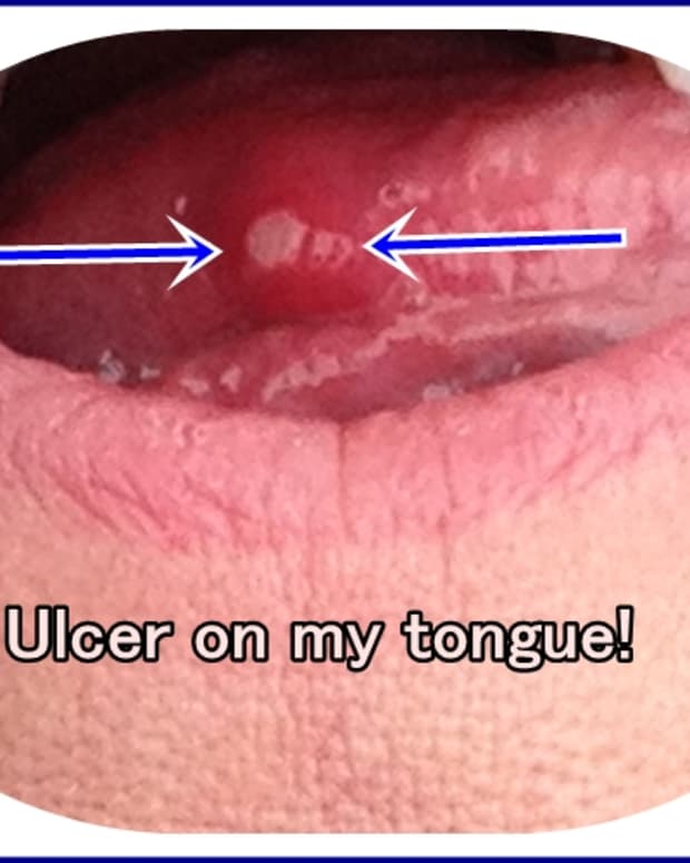 home-remedies-for-mouth-ulcers