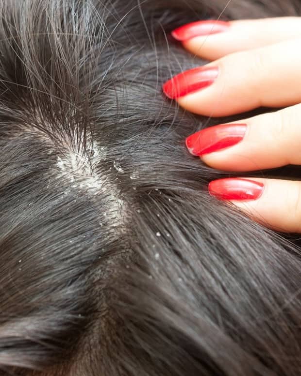 cure-for-dry-flaky-scalp-at-your-home