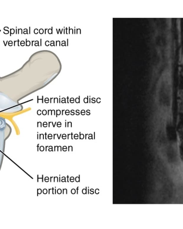 herniated-or-slipped-disks-bacteria-and-back-pain