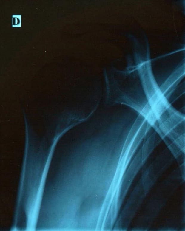 what-to-expect-on-the-day-of-arthroscopic-shoulder-surgery