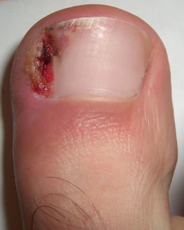 ingrown-toenail-home-treatment-remedies-and-relief-for-ingrown-toenails