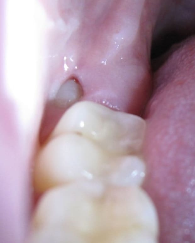 20 Tips for Treating Wisdom Tooth Pain. 