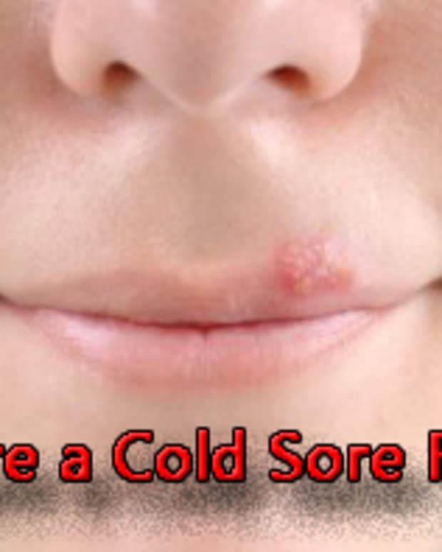 the-best-way-to-get-rid-of-a-cold-sore-remedies-for-every-stage
