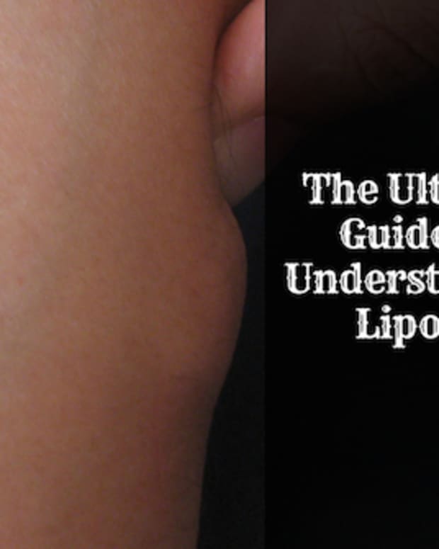 what-you-should-know-about-lipoma