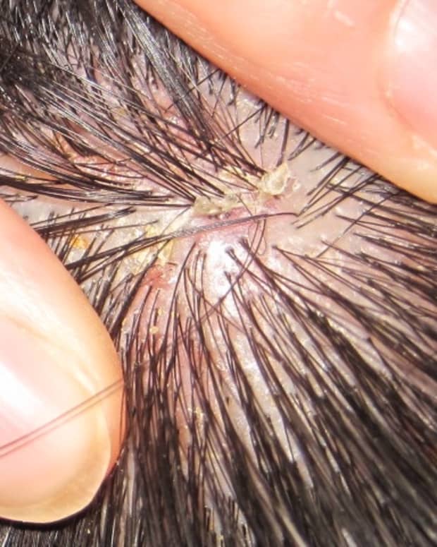 psoriasis-of-the-scalp