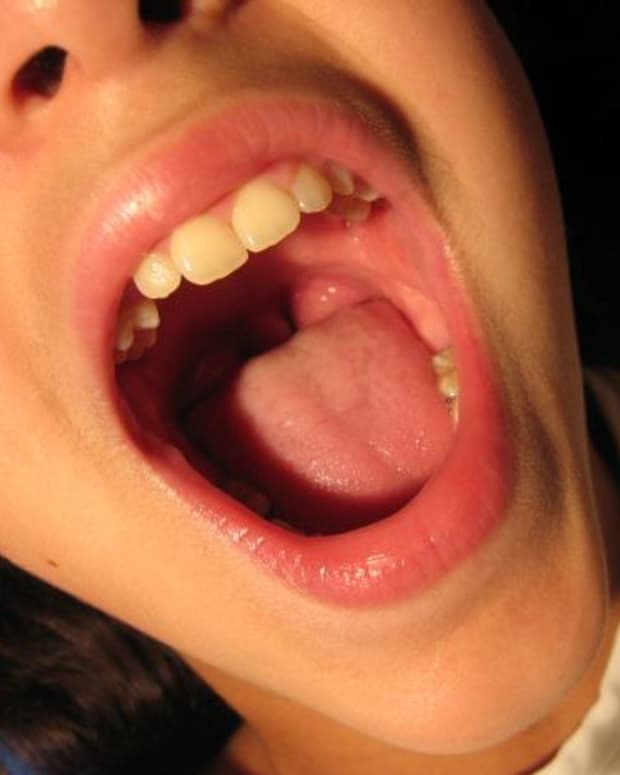 possible-causes-of-bump-on-roof-of-mouth