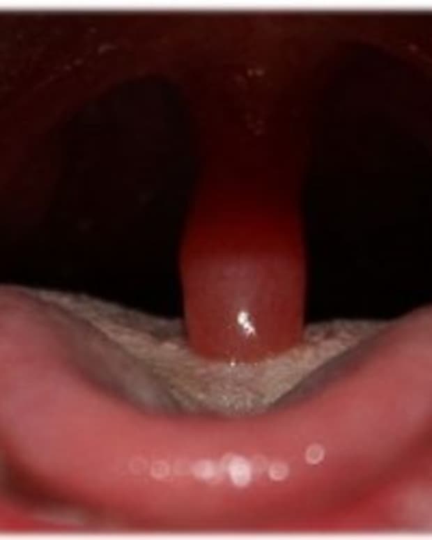 swollen-uvula-2