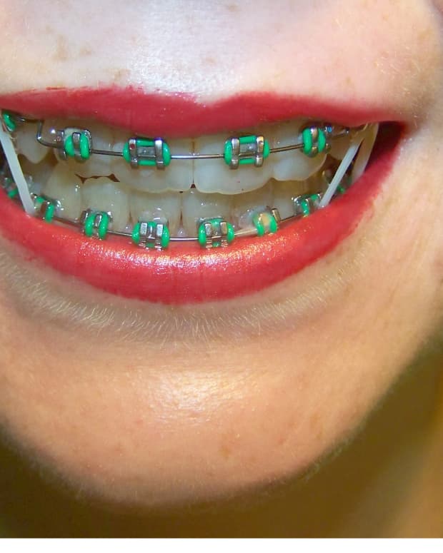 tips-and-advice-for-anyone-with-braces