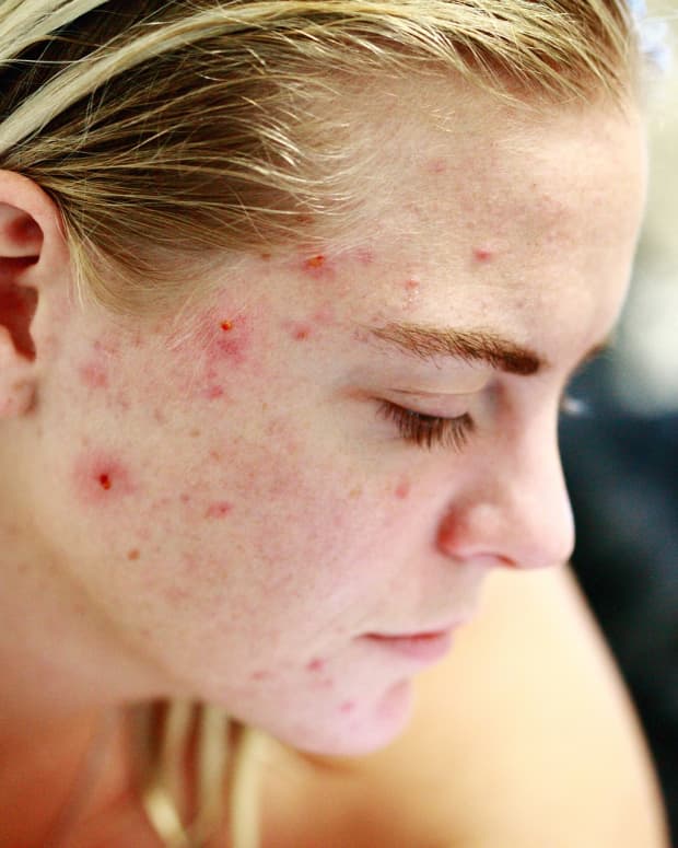 how-to-get-rid-of-teenage-spots