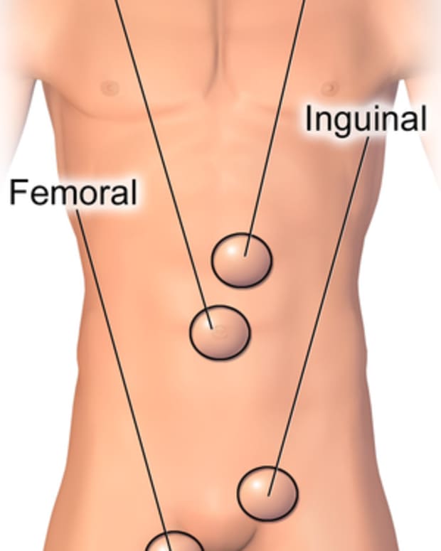 femoral-hernia