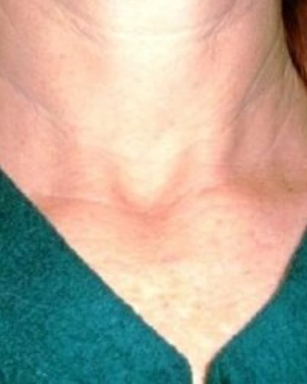 thyroid-cancer-information