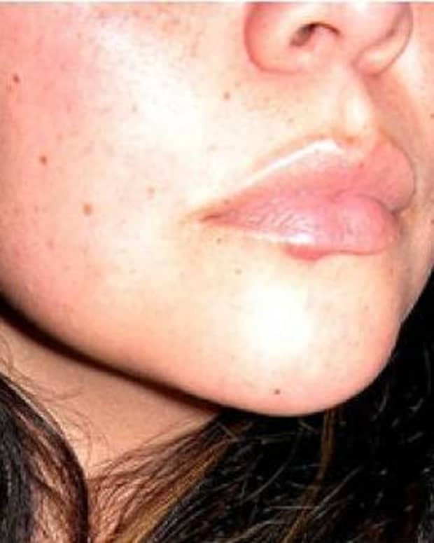 how-to-beat-a-cold-sore