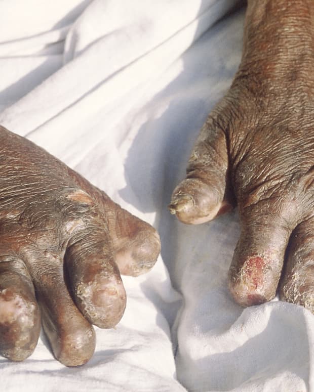 leprosy-bacteria-macrophages-and-nerve-damage