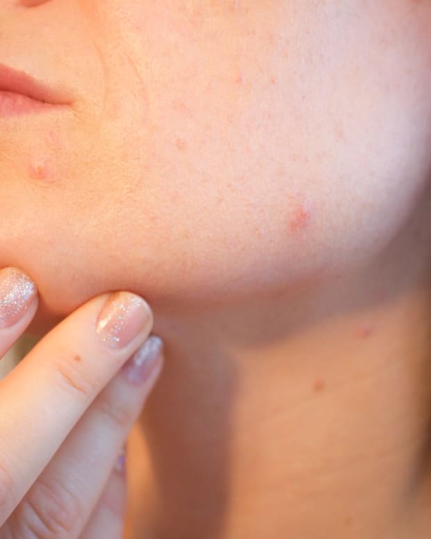 acne-causes-general-care-and-treatment