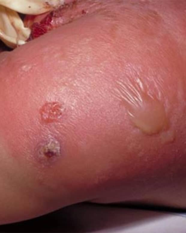 secondary staphylococcal infection at the smallpox vaccination site