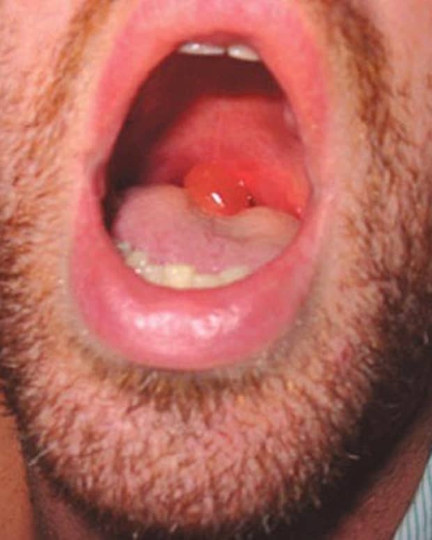 swollen-uvula