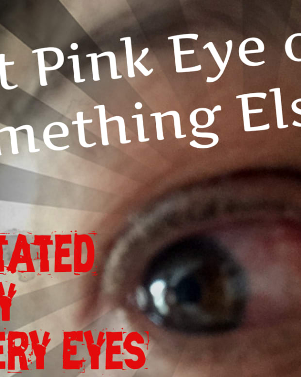 red-irritated-itchy-watery-eyes-is-it-pink-eye-or-something-else