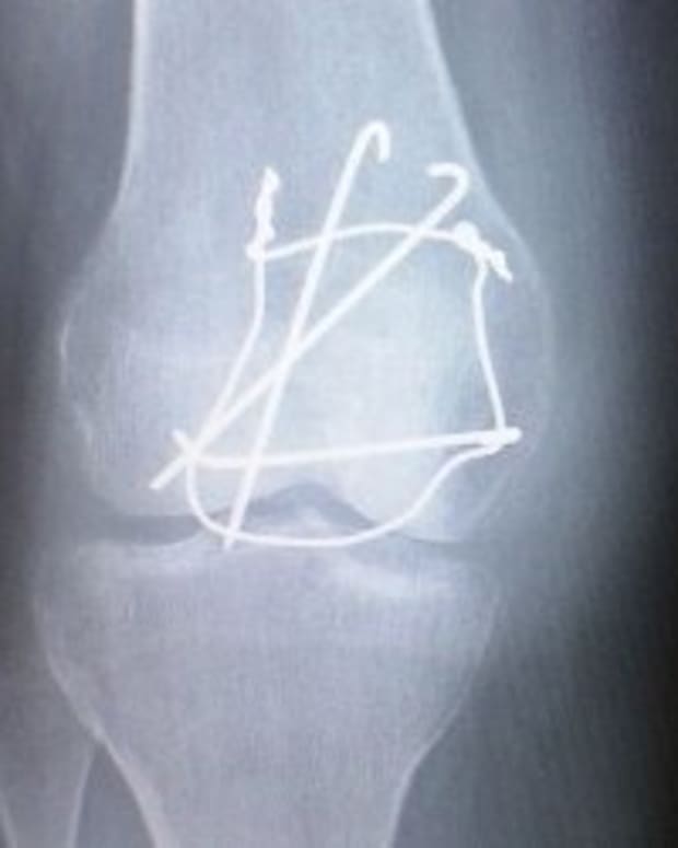 my-broken-knee