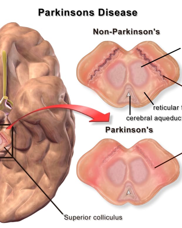 parkinsons-disease-biology-and-the-hope-of-stem-cell-treatment