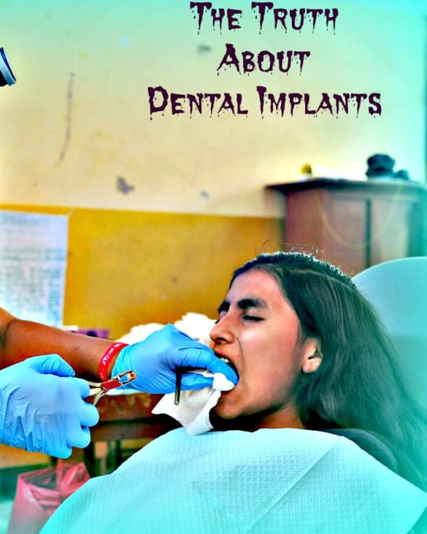 dental-implants-what-dentists-dont-tell-you-can-hurt