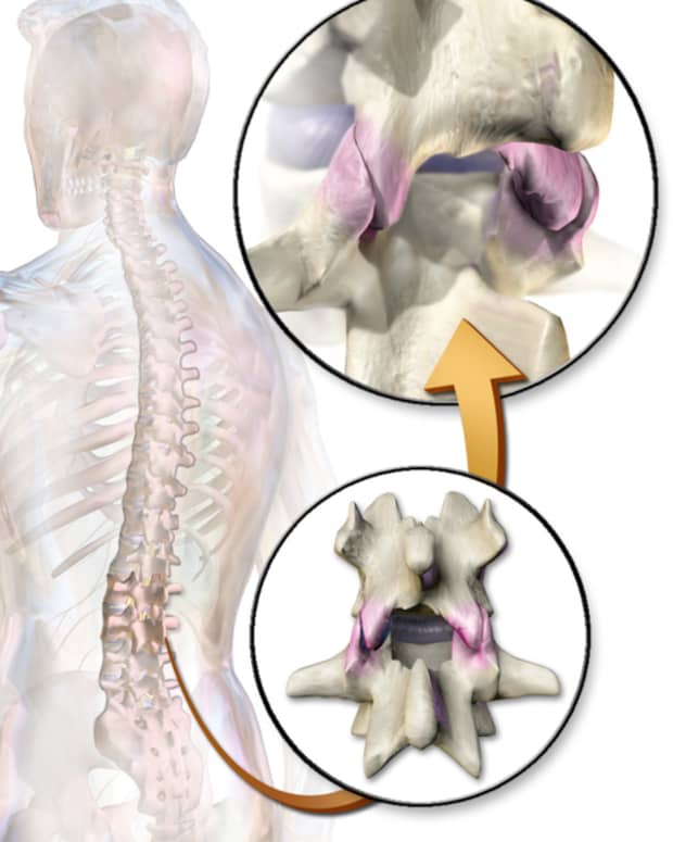 injections-for-back-pain-facet-injections-or-medial-branch-blocks-and-radiofrequency-ablation