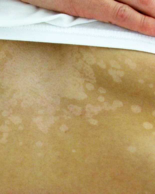 white-patches-and-spots-that-wont-tan-dark-patches-on-back-and-shoulders-tinea-versicolor-can-easily-be-treated