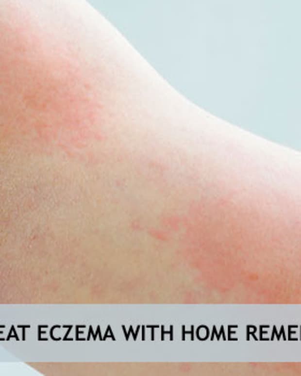natural-eczema-treatment-what-works-best-for-you