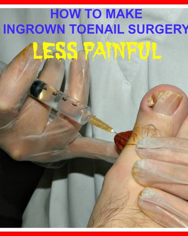 how-to-make-ingrown-toenail-surgery-less-painful