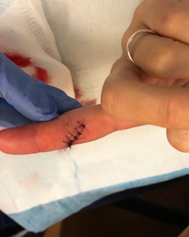 how-to-restore-feeling-in-a-numb-finger-after-stitches