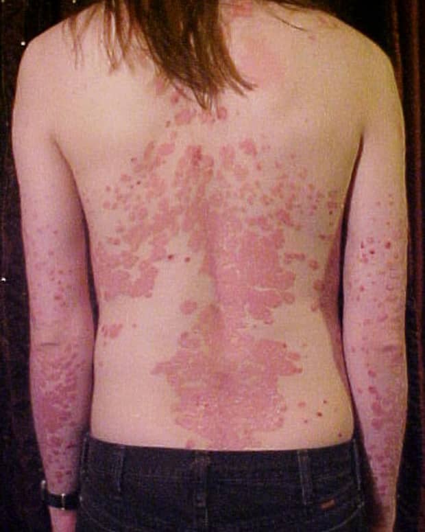 effective-home-remedies-for-psoriasis