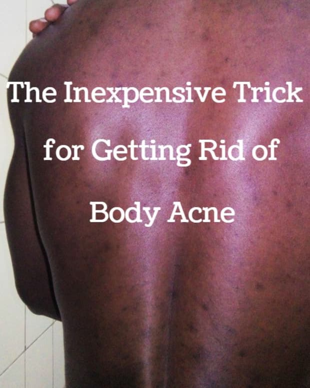 get-rid-of-body-acne-naturally-at-no-extra-cost