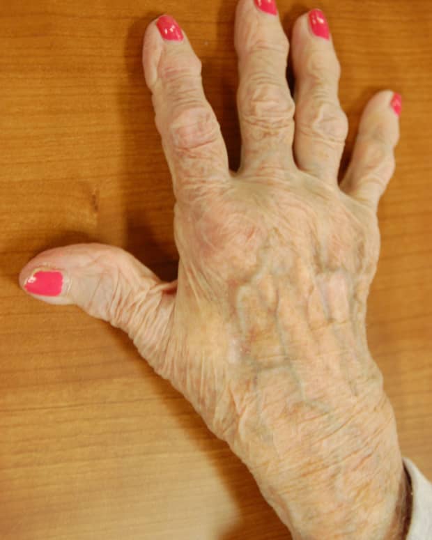 arthritis-relief-heat-treatment-options