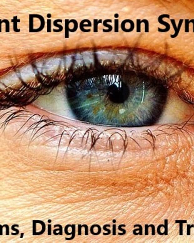 pigment-dispersion-syndrome-my-experience-of-this-eye-condition