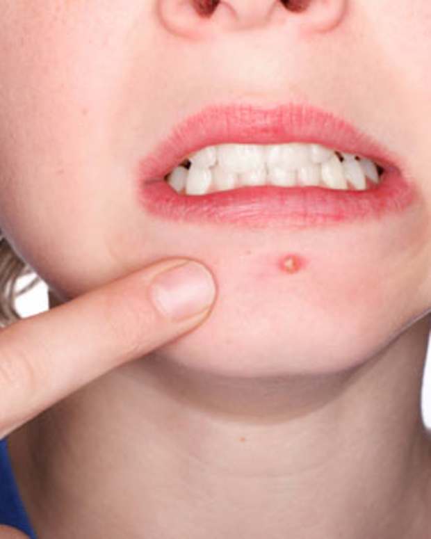 how-to-remove-pimples-fast