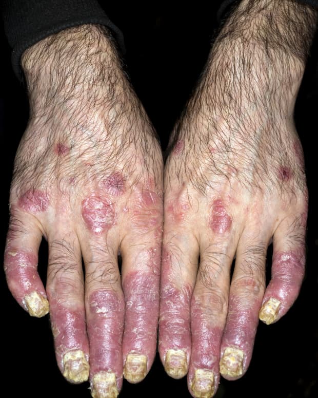 psoriasis-vs-eczema