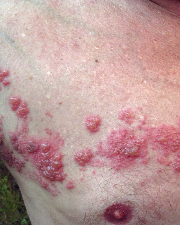 herpes-zoster-shingles-symptoms-and-treatment