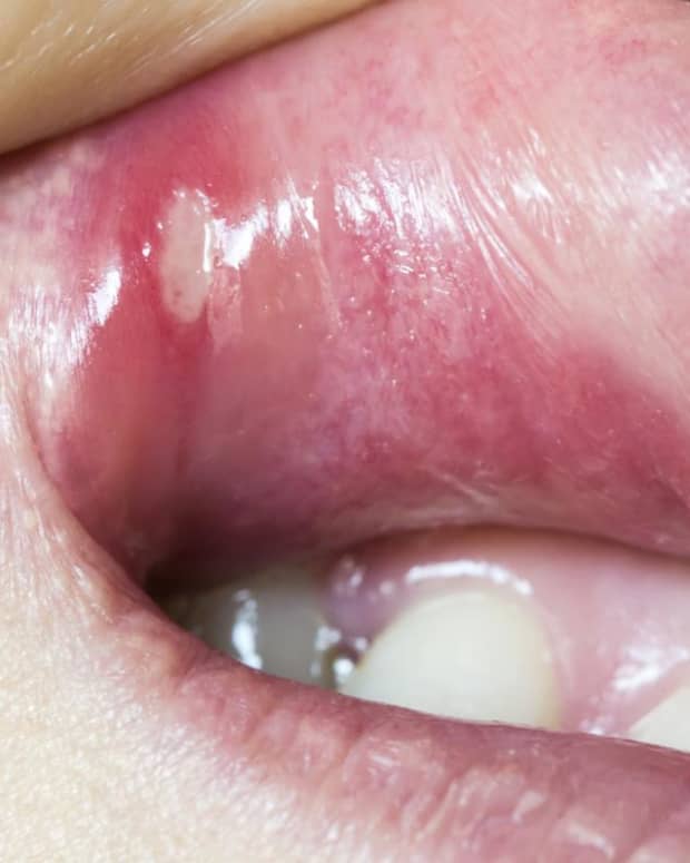 natural-ways-to-treat-cold-sores-and-mouth-ulcers