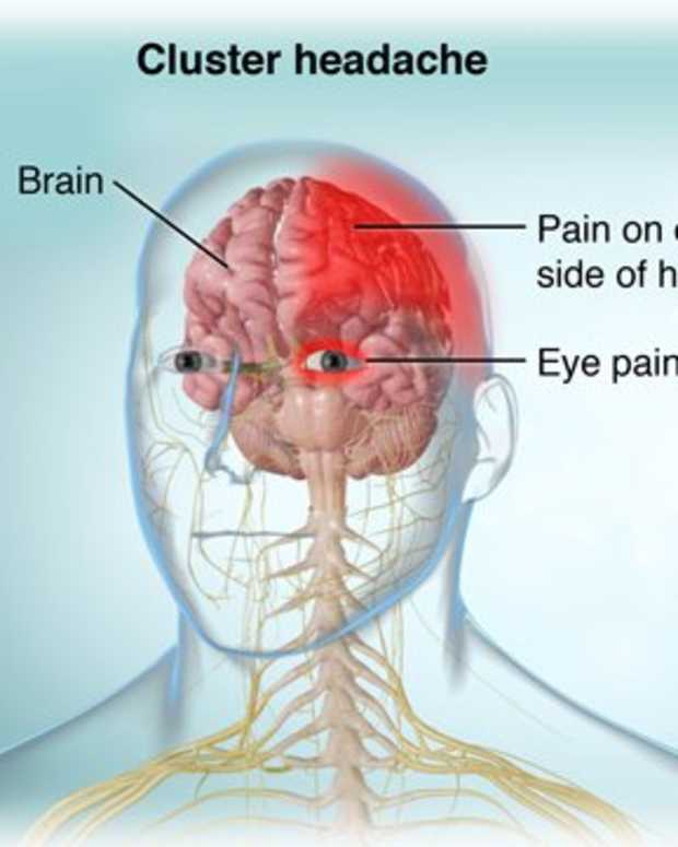 How I Managed to Cure My Cluster Headache YouMeMindBody