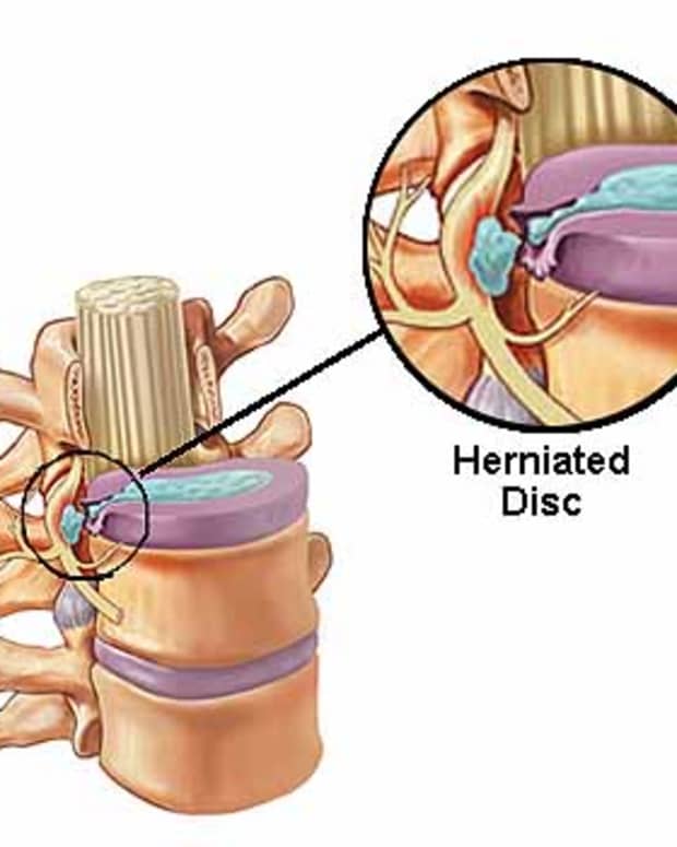 herniated-disc-treatment