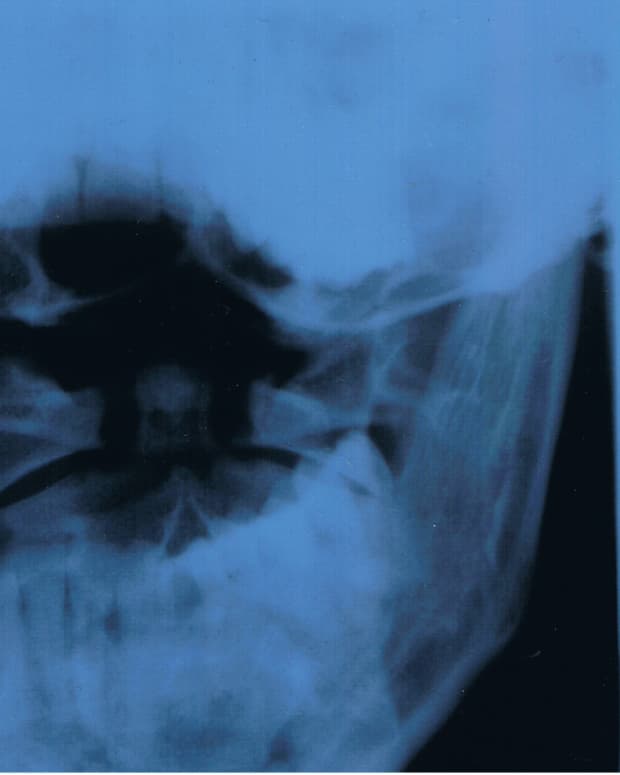 Here is the X-ray of my jaw with the huge gap on one side from the dentist removing my wisdom teeth