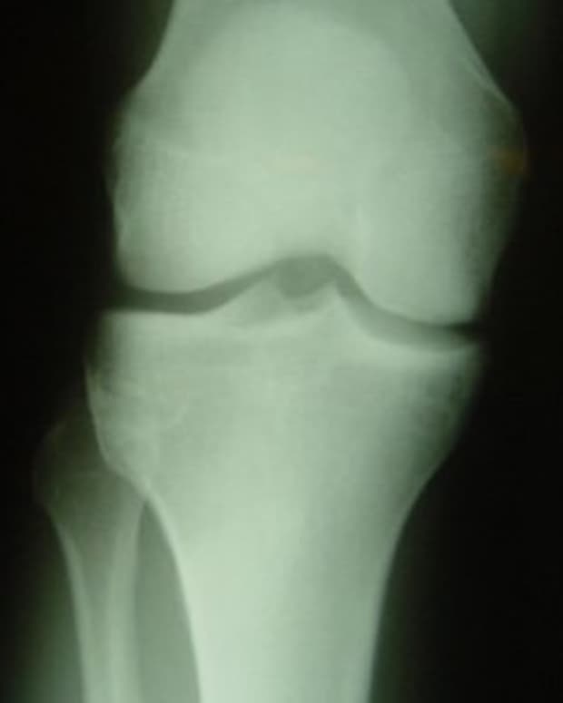 the-normal-knee-x-ray-what-are-its-features