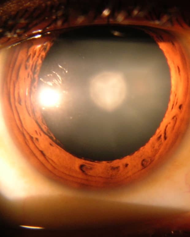 crystalens-cost-with-cataract-surgery