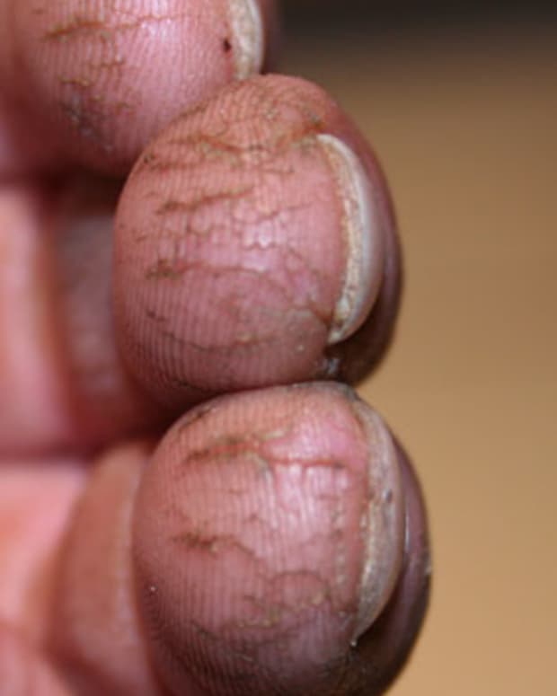 cracked-fingertips-and-how-to-treat-them