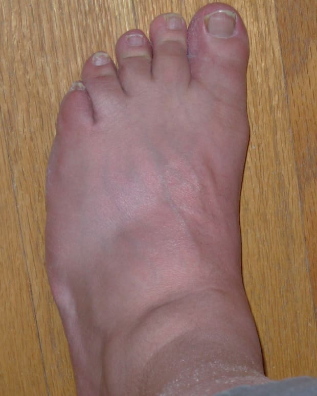 8-foods-to-avoid-with-gout
