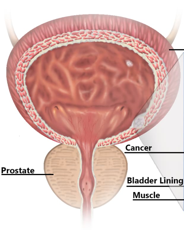 bladder-cancer-and-bcg-infection