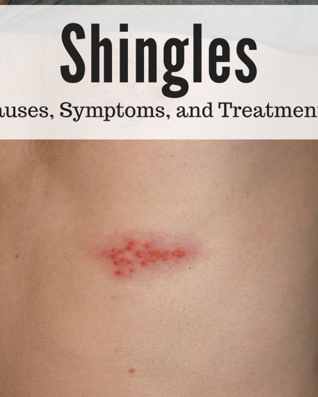 shingles-a-serious-painful-viral-disease