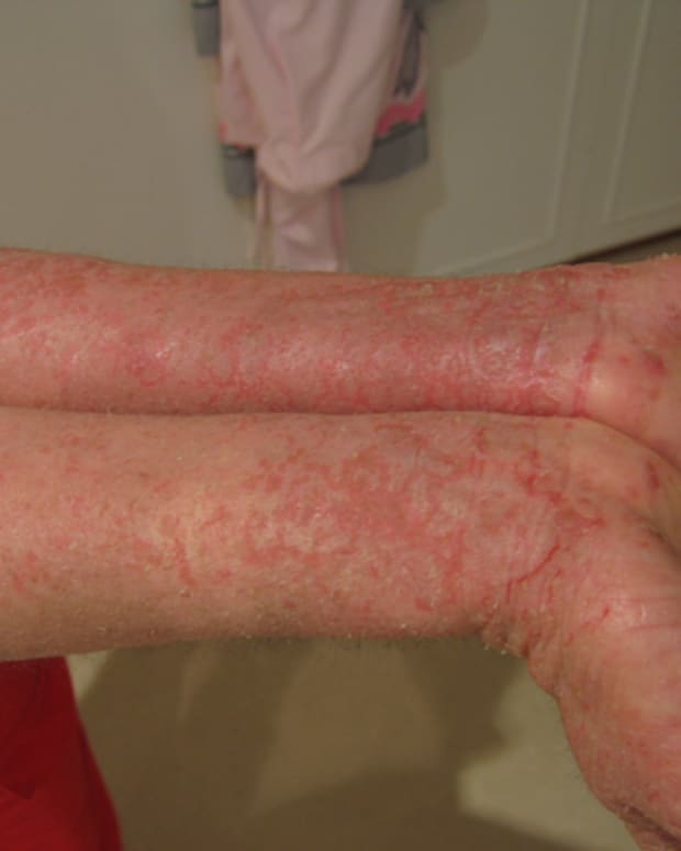 treatment-of-dyshidrotic-eczema-and-possible-causes