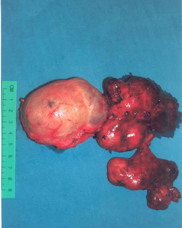 My very enlarged thyroid after the operation!