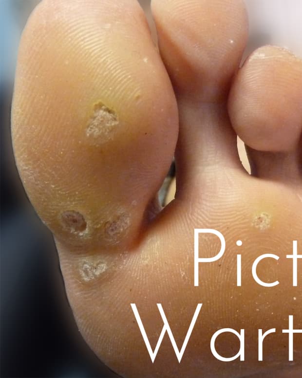 picture-of-warts