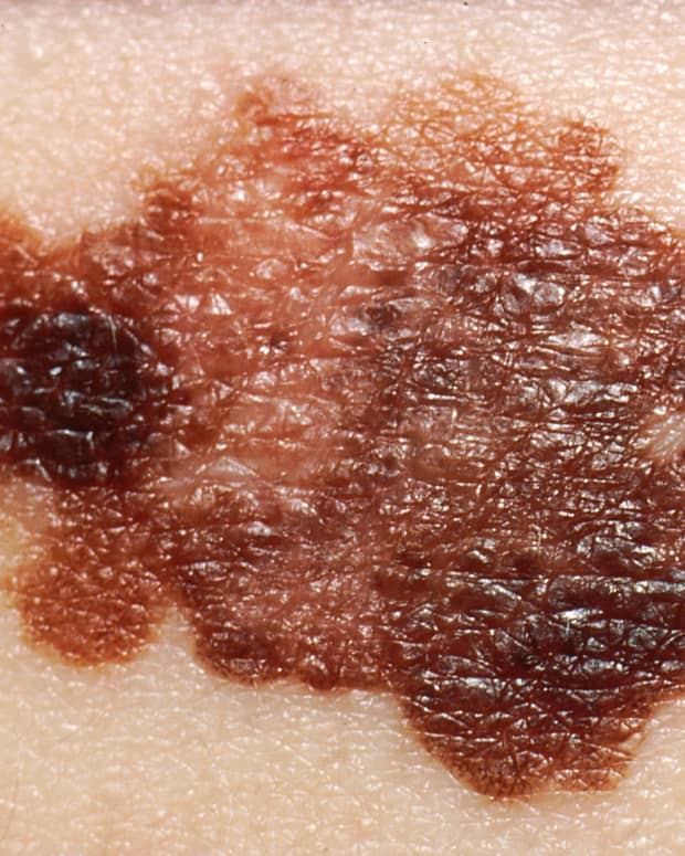key-information-about-melanoma